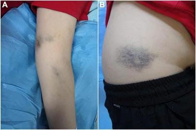 Case report: A case of acquired von Willebrand syndrome as onset clinical presentation of systemic lupus erythematosus manifested as epistaxis and pulmonary hemorrhage